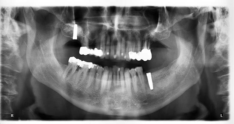 Mehr Sicherheit bei vertikalen Knochenaugmentationen